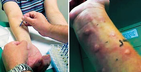 피부 반응 검사